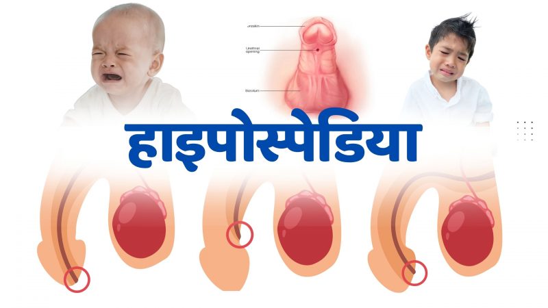 Hypospadias